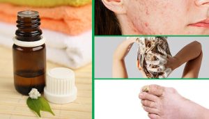 روغن درخت چای 100% طبیعی tea tree oil essential oil on tea tree oil